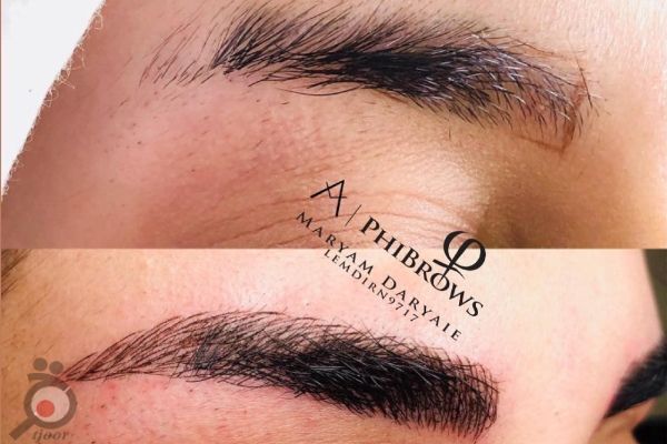 تخفیف میکروبیلدینگ به روش فیبروز به مناسبت ولنتاین