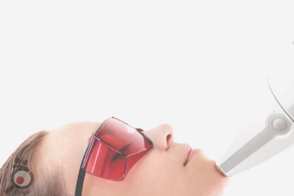 تخفیف لیزر موهای زائد