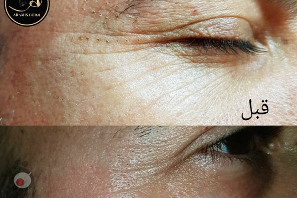 تخفیف ویژه لیفت و جوانسازی صورت