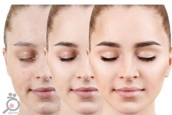 تخفیف پکیج جوانسازی صورت