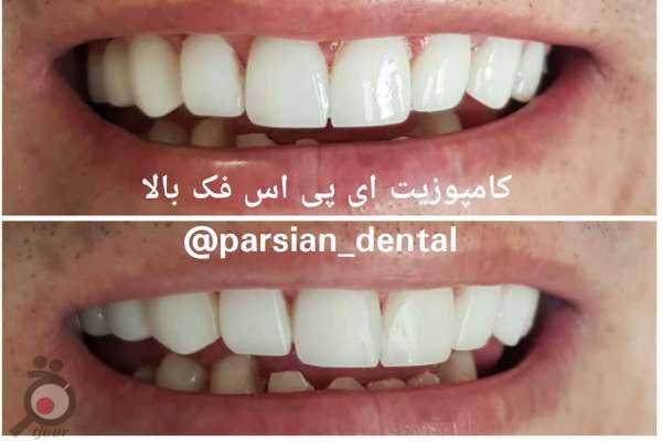 تخفیف کامپوزیت دندان