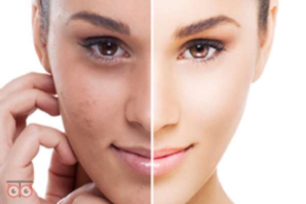 تخفیف بوتاکس و تزریق ژل