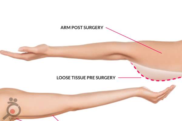 تخفیف براکیوپلاستی