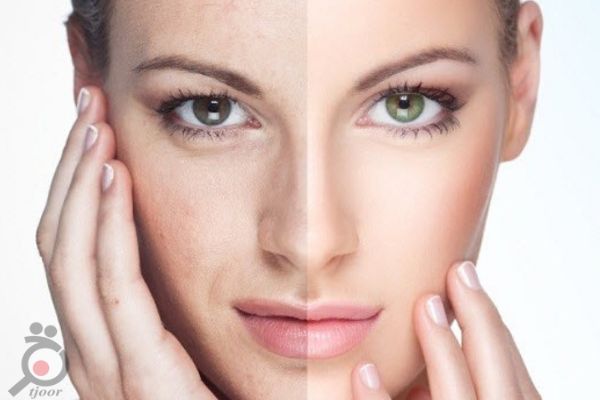 تخفیف رفع چین و چروک پلک و صورت