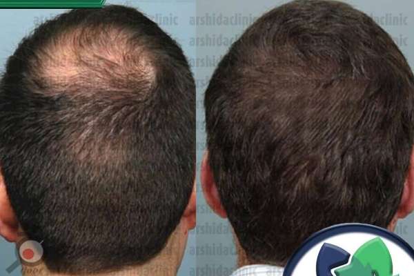 تخفیف کاشت مو و ابرو تخفیف کاشت مو و ابرو