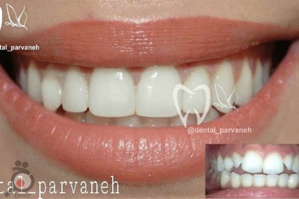 تخفیف ویژه طرح لبخند به مدت محدود