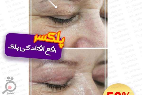 تخفیف تابستانی مرکز آیریس بر روی خدمات پلکسر و اولتراپی