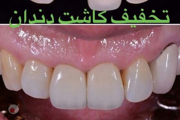 تخفیف ویژه کاشت دندان