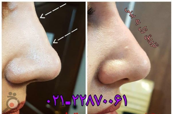 تخفیف تزریق ژل اصلاح فرم بینی