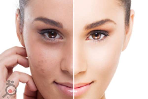 تخفیف اولتراپی تخفیف اولتراپی