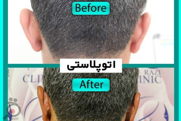 تخفیف ویژه لیزر موهای زائد