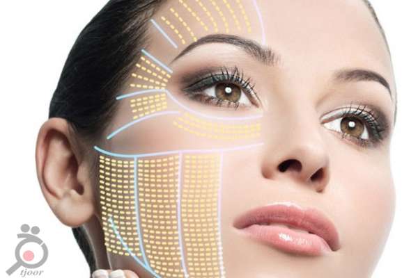 تخفیف ویژه عمل لیفت صورت