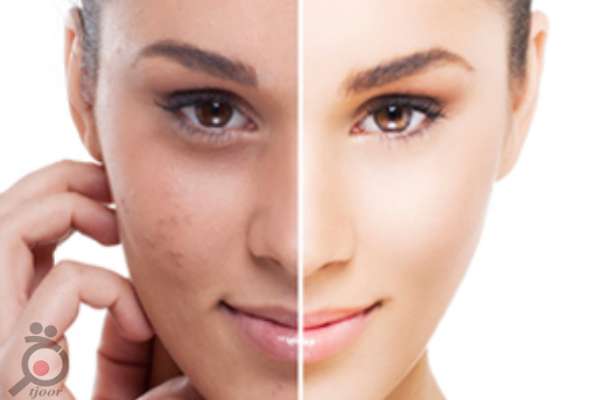 تخفیف خدمات جوانسازی و لیفت صورت