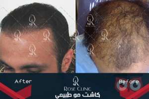 تخفیف ویژه کاشت مو تخفیف ویژه کاشت مو