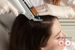 تخفیف ویژه مزوتراپی موی سر تخفیف ویژه مزوتراپی موی سر