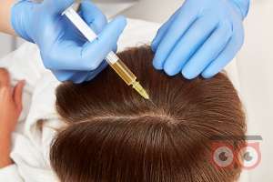 تخفیف ویژه مزوتراپی موی سر تخفیف ویژه مزوتراپی موی سر