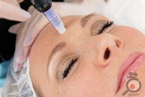 تخفیف ویژه مزوتراپی تخفیف ویژه مزوتراپی