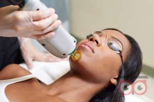 تخفیف ویژه لیزر تخفیف ویژه لیزر