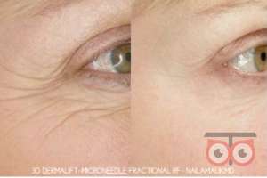 تخفیف ویژه RF فرکشنال تخفیف ویژه RF فرکشنال