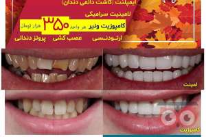 تخفیف ویژه ایمپلنت دندان تخفیف ویژه ایمپلنت دندان