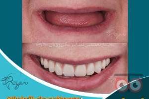 تخفیف ویژه ایمپلنت دندان