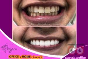 تخفیف ویژه ارتودنسی تخفیف ویژه ارتودنسی