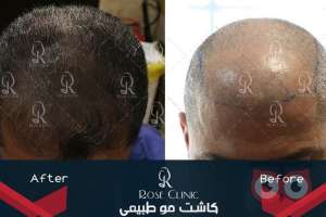 تخفیف ویژه کاشت مو تخفیف ویژه کاشت مو