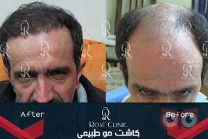 تخفیف ویژه کاشت مو تخفیف ویژه کاشت مو