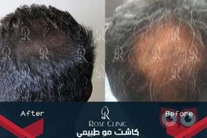 تخفیف ویژه کاشت مو تخفیف ویژه کاشت مو