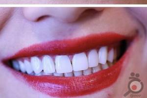 تخفیف ویژه کامپوزیت تخفیف ویژه کامپوزیت