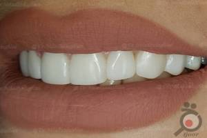 تخفیف ویژه کامپوزیت تخفیف ویژه کامپوزیت