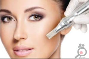 تخفیف ویژه میکرونیدلینگ تخفیف ویژه میکرونیدلینگ