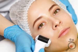 تخفیف ویژه میکرونیدلینگ تخفیف ویژه میکرونیدلینگ