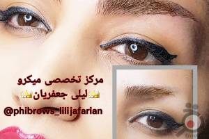 تخفیف میکروپیگمنتیشن تخفیف میکروپیگمنتیشن