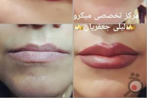 تخفیف میکروپیگمنتیشن تخفیف میکروپیگمنتیشن