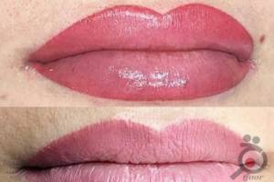 تخفیف میکروپیگمنتیشن تخفیف میکروپیگمنتیشن