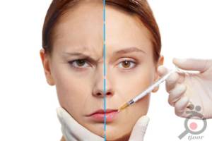 جشنواره تزریق ژل لب جشنواره تزریق ژل لب