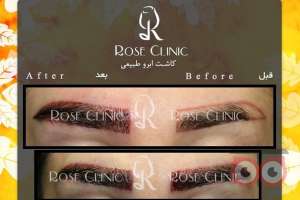 تخفیف کاشت ابرو تخفیف کاشت ابرو