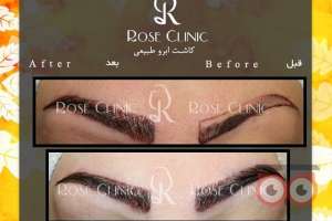 تخفیف کاشت ابرو تخفیف کاشت ابرو