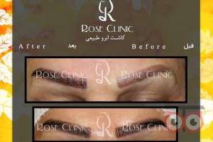 تخفیف کاشت ابرو تخفیف کاشت ابرو