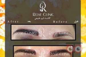تخفیف کاشت ابرو تخفیف کاشت ابرو