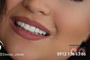 تخفیف ویژه کامپوزیت تخفیف ویژه کامپوزیت