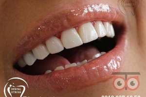 تخفیف ویژه کامپوزیت تخفیف ویژه کامپوزیت