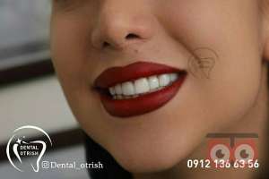 تخفیف ویژه کامپوزیت تخفیف ویژه کامپوزیت