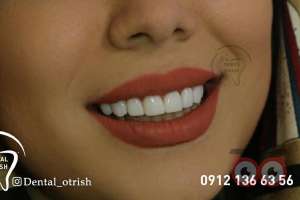 تخفیف ویژه کامپوزیت تخفیف ویژه کامپوزیت