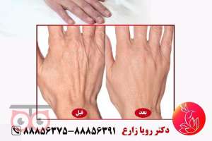 تخفیفات ویژه ماه مبارک رمضان در کلینیک زیبایی لوتوس زیر نظر دکتر رویا زارع تخفیفات ویژه ماه مبارک رمضان در کلینیک زیبایی لوتوس زیر نظر دکتر رویا زارع