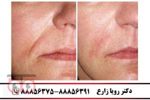 تخفیفات ویژه ماه مبارک رمضان در کلینیک زیبایی لوتوس زیر نظر دکتر رویا زارع تخفیفات ویژه ماه مبارک رمضان در کلینیک زیبایی لوتوس زیر نظر دکتر رویا زارع