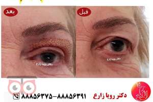 تخفیفات ویژه ماه مبارک رمضان در کلینیک زیبایی لوتوس زیر نظر دکتر رویا زارع تخفیفات ویژه ماه مبارک رمضان در کلینیک زیبایی لوتوس زیر نظر دکتر رویا زارع