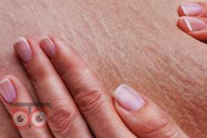 رفع سلولیت و ناهمواری های بدن رفع سلولیت و ناهمواری های بدن