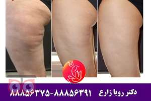 رفع سلولیت و ناهمواری های بدن رفع سلولیت و ناهمواری های بدن